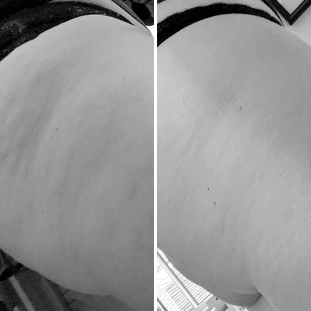 Cellulite before/after