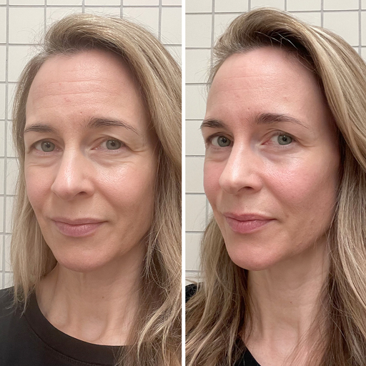 Kvinna 40+ före och efter kollagenpulver från Oslo Skin Lab