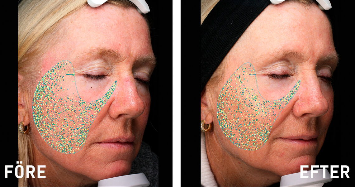 Before-after_web_article_Ann-Cathrin1_1140x600_0122.jpg